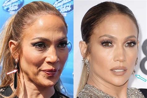 Pin By Katherine P On Body Botox Face Jennifer Lopez Plastic