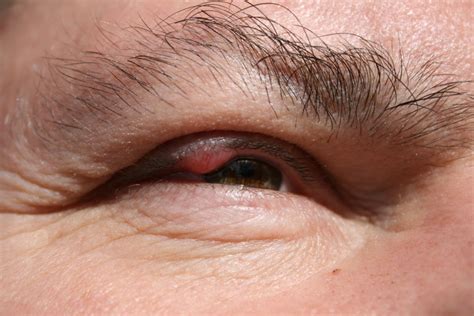 Eyelid Inflammation Blepharitis Causes Symptoms And Treatment