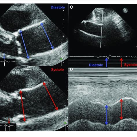 Evaluation Of Aortic Strain Using Echocardiographic Features Either