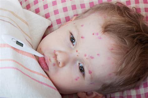Baby Girl S Arm Showing Rash From Viral Meningitis Ph