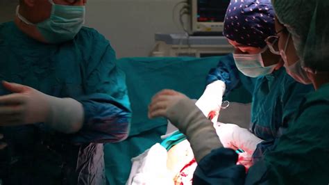 Twin Birth Caesarean Sectionsecond Baby Born With An Amniotic Sac