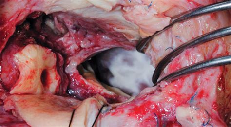 Its intracardiac effects include severe valvular insufficiency, which may lead to intractable congestive heart failure and. 'Atlas of Infective Endocarditis' Aims to Map Out Better ...
