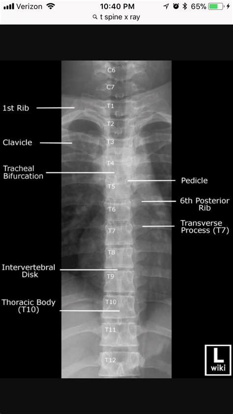 AP Thoracic Spine Xray Radiology Babe Radiology Imaging Radiology