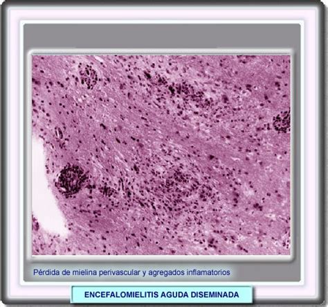 La encefalomielitis diseminada aguda ( adem ), o encefalomielitis desmielinizante aguda , es una enfermedad autoinmune rara caracterizada por un ataque repentino y generalizado de inflamación en el cerebro y la médula espinal. ATLAS DE NEUROLOGIA