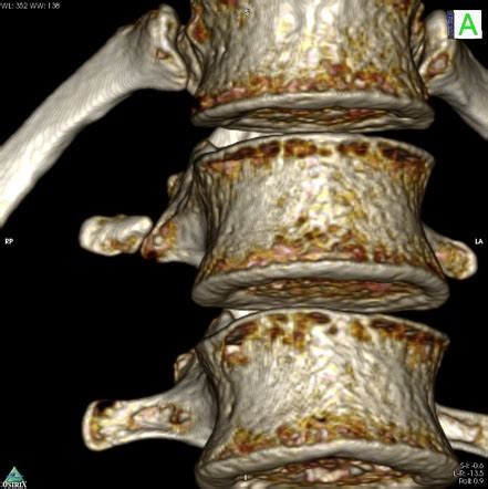 Transverse Process Fracture Radiology Reference Article Radiopaedia Org