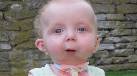 Girl With Rare Condition Born Without Jaw Wsyx