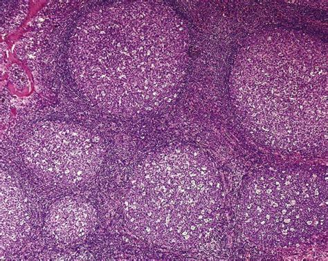 Mature Lymphoid Neoplasms Oncohema Key