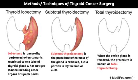Thyroid Cancer Surgery Procedure Risks And Associated Complications