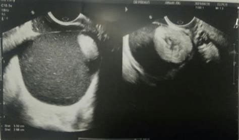 The Ultrasound View Of The Dermoid Cyst Observed In The Retroperitoneal