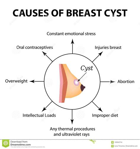Causes Of Cyst In The Mammary Gland World Breast Cancer Day Tumor