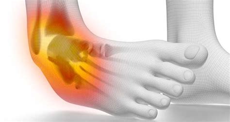 Acute Ankle Injuries Sprains And Fractures Symptoms And Causes