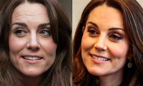 Läkaren Kate Middleton Har Gjort Det Här Skönhetsingreppet