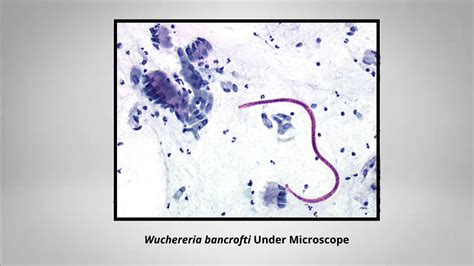 Lymphatic Filariasis Wuchereria Bancrofti