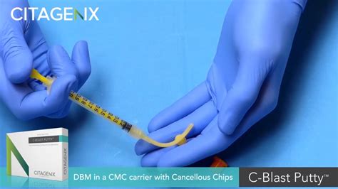 Bone Graft Dbm With Cancellous Chips In A Cmc Carrier C Blast Putty