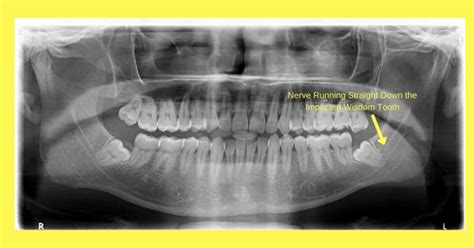 Does Wisdom Teeth Removal Cause Nerve Damage Or Dental Paresthesia