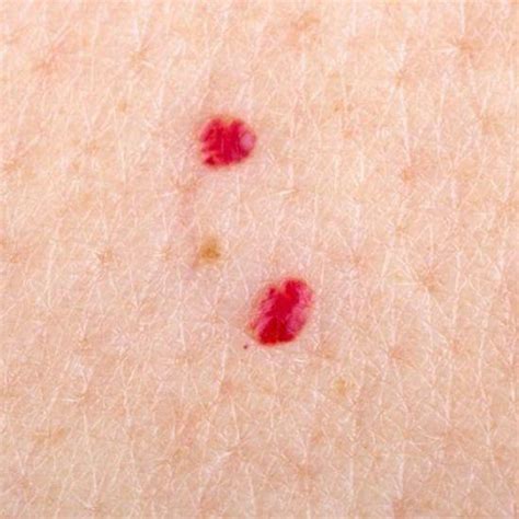 Skin Treatments For Skin Tags Age Spots Broken Capillaries