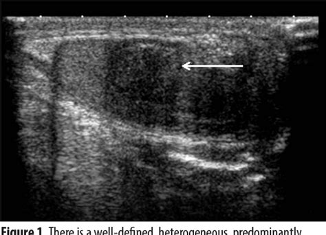 Figure 3 From Sonographic Appearance Of Testicular Adrenal Rest Tumour