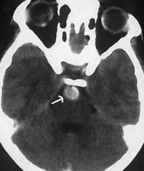 Plain Ct Scan Showing A Well Defined Hyperdense Lesion Open I