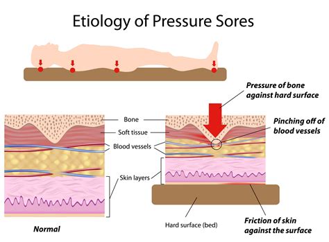 Development Of Pressure Ulcers Causes And Signs Scottish Acquired