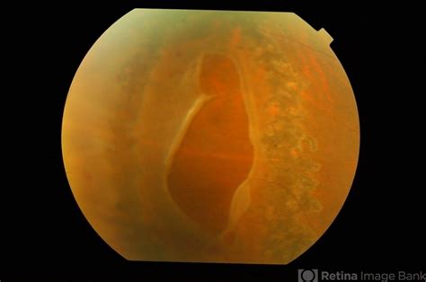 Large Traumatic Retinal Tear Retina Image Bank