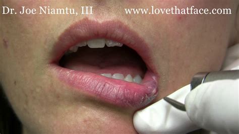 Venous Lake Hemangioma Treatment With 940 Laser By Dr Joe Niamtu