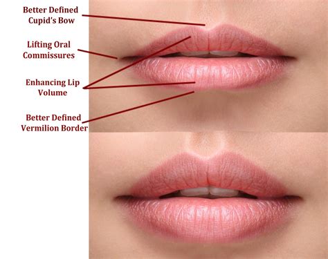 lip reshaping lip augmentation lip reduction in bangalore
