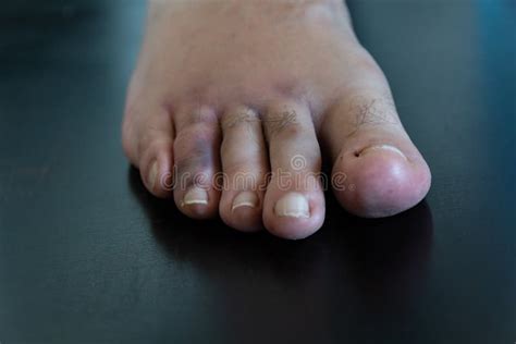 A Male Broken Foot Toe Stock Image Image Of Painful 194047661