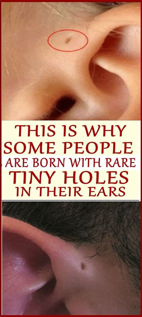 This Is Why Some People Are Born With Rare Tiny Holes In Their Ears