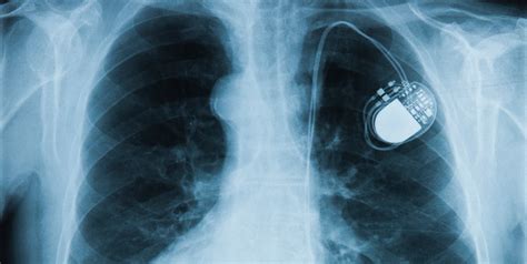 Worlds Smallest Cardiac Pacemaker Implanted By Farrer Park Hospital