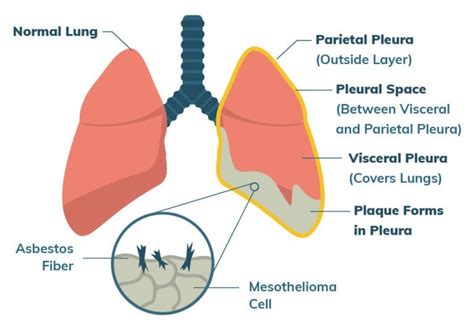 Irritation from asbestos fibers can cause excess fluid to build up between the two layers of the pleura. Pleural Mesothelioma | M A N O X B L O G
