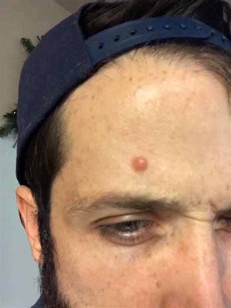 What Is This Bump On My Forehead That I Cant Get Rid Of Its Came Up