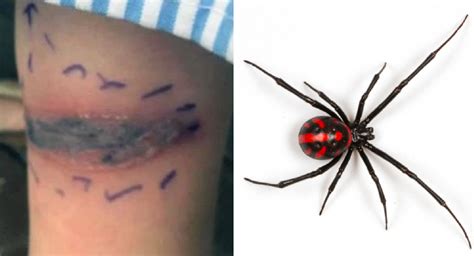 Black Widow Spider Bite Images