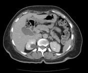 Bosniak Classification System Of Renal Cystic Masses Radiology Reference Article Radiopaedia Org