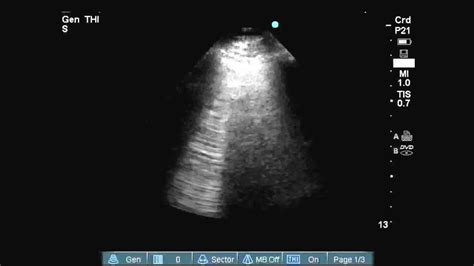 B Lines On Lung Ultrasound Youtube
