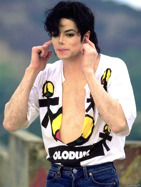 Vitiligo Michael Jackson Michael Dawson Hee Man Vitiligo Treatment