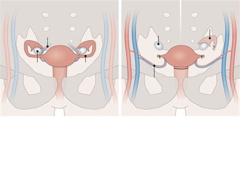 Uterus Transplants May Soon Help Some Infertile Women In The Us