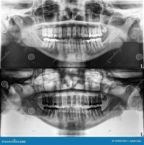 Panoramic Dental Xray Fixed Teeth Dental Amalgam Seal Wisdom Teeth