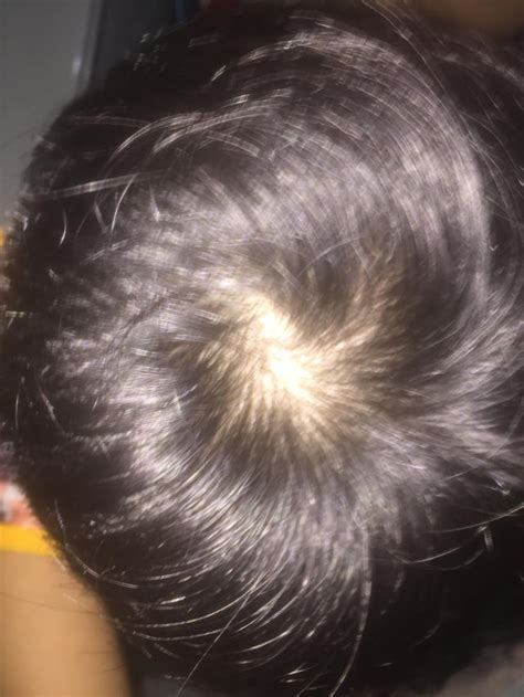 Is This A Normal Hair Whorl Or Is It Hair Loss Rmalehairadvice