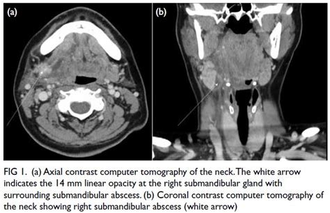 Abscess Formation Following Accidental Ingestion Of Fish Bone With