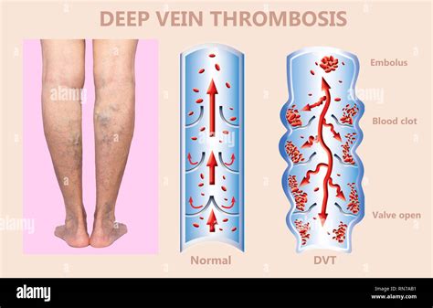 Deep Vein Thrombosis Hi Res Stock Photography And Images Alamy