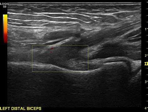 Distal Biceps Tendon Ultrasound