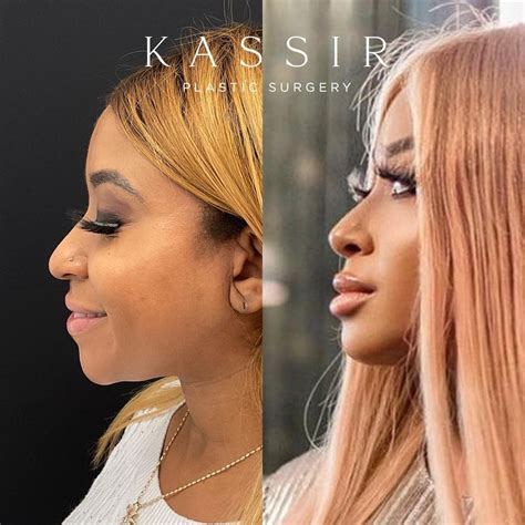 Black Ethnic Rhinoplasty Before And After Gallery — Kassir Plastic