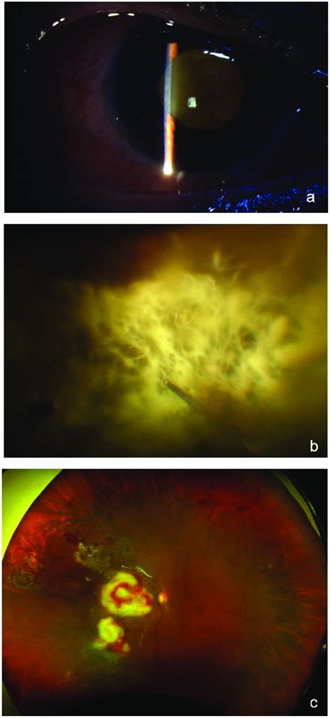 A Anterior Segment Examination Showing Cataractous Lens With A Yellow