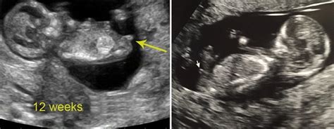 12 Weeks Pregnant Symptoms Ultrasound Belly Baby Development