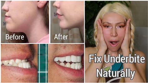 How To Fix An Underbite Naturally Correcting Protruding Jaw And Chin