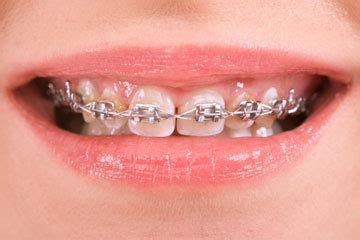 Carat is a unit of weight for diamonds where 1 carat= 0.2 grams. How Much Do Braces Cost in the UK? - The Dental Guide