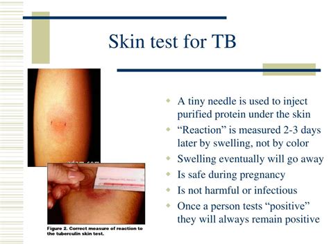 ppt tuberculosis powerpoint presentation free download id 6803376