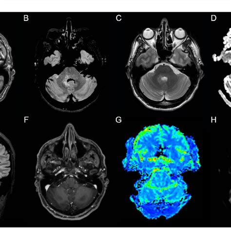 Patient 2 Mri Scans Of The Brain Shows T2 Weighted And Fluid Attenuated