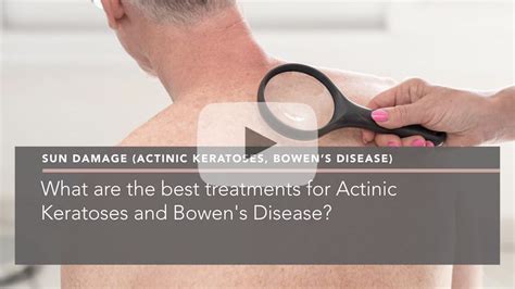 What Is The Best Treatment For Actinic Keratoses And Bowens Disease