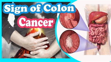 If you find that you do have colon cancer, then please before you consider all of your options and go down the chemotherapy route, see this article on immunotherapy gcmaf and how. 6 Warning SIgns of Colon Cancer - YouTube